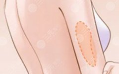 上臂抽脂會(huì)損傷神經(jīng)嗎？多掏6分鐘，少踩6%損傷率：上臂抽脂避坑實(shí)錄