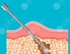 超聲溶脂和光纖溶脂哪個(gè)安全？風(fēng)險(xiǎn)點(diǎn)各有側(cè)重，避坑關(guān)鍵看適配