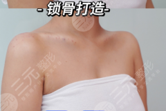 鎖骨整形有什么后遺癥？和“術(shù)式+醫(yī)院”直接掛鉤