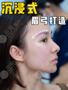 眉弓骨填充多少錢？填充價格=材料+技術(shù)+安全保障