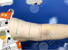 手臂黃金微雕多長時間能看到效果？7天消腫顯線條