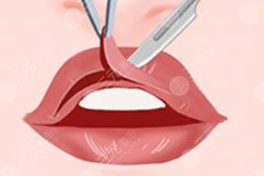 重唇可以怎樣改善？實(shí)地跟拍手術(shù)全流程，畫線→縫合一步不落