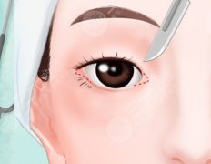 做外眼角會(huì)回縮嗎？術(shù)前到底要干嘛？一張清單直接抄