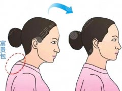 富貴包微創(chuàng)手術(shù)多久可以恢復(fù)？切口不到1厘米，恢復(fù)竟要這么久？