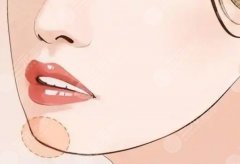 peek假體下巴的口碑和評(píng)價(jià)，材料、價(jià)錢、滿意度一次聊透