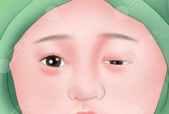 填眉弓可以改善眼皮下垂嗎？眼皮下垂和眉弓關(guān)系有多大？附真實(shí)體驗(yàn)與科普
