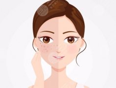 激光祛雀斑一次能做干凈嗎？到底打幾遍才安心？價(jià)格、痛感、恢復(fù)期一次說清