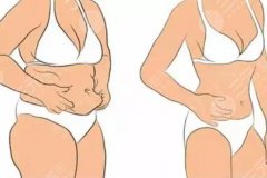 射頻溶脂和抽脂哪個(gè)好？不想踩坑？關(guān)于射頻溶脂和抽脂的對比，看這一篇就夠