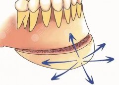 頦成型和正頜哪個(gè)風(fēng)險(xiǎn)大？不是臉大就要截骨：頦成型和正頜的真門檻