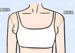 副乳抽脂恢復(fù)期多久？腫幾天？疼幾天？能上班幾天？一次說(shuō)清