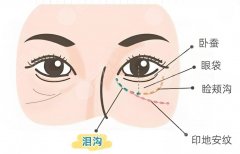 膚麗美填充淚溝怎么樣？?jī)r(jià)格、效果、注意事項(xiàng)一網(wǎng)打盡