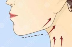 下頜緣抽脂多久才能恢復(fù)？這份“下頜緣抽脂恢復(fù)日歷”直接抄作業(yè)