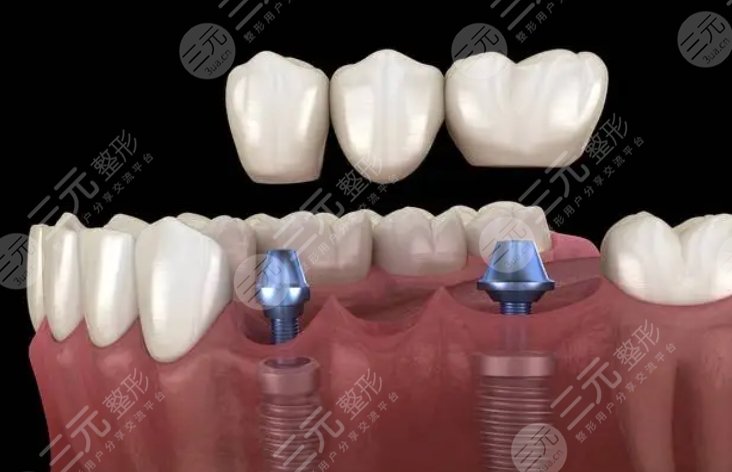 牙齒種植