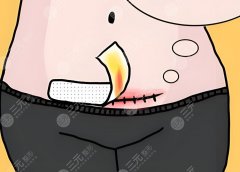 全腹壁祛皮祛脂效果好嗎？從住院到拆線，全腹壁恢復(fù)期30天流水賬