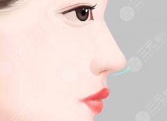 做鷹鉤鼻手術(shù)拆線會(huì)痛嗎？看了這份滿意度表格再?zèng)Q定做不做