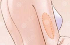 上臂抽脂疼不疼？痛感、價(jià)格、恢復(fù)，一次打包講清楚