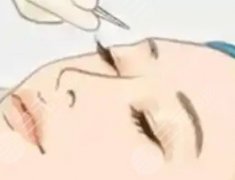 微創(chuàng)雙眼皮和埋線雙眼皮有什么不同？想省錢(qián)又怕疼？先搞清微創(chuàng)和埋線的“真差價(jià)”