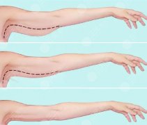 蝴蝶袖手臂吸脂恢復(fù)期，術(shù)后價格+恢復(fù)時間雙表，一眼看懂