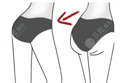 自體脂肪豐臀和豐體針哪個維持時間長?哪種豐臀方式效果更持久劃算