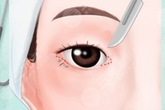 開內(nèi)眼角后出現(xiàn)疤痕增生怎么辦？花了錢還留疤？內(nèi)眼角術(shù)后“補(bǔ)救手冊”來了