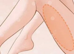 手臂抽脂和大腿抽脂哪個(gè)疼？花幾萬(wàn)塊買(mǎi)罪受？先搞清楚哪塊肉更嬌氣