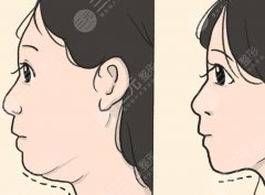 雙下巴黃金微雕要拆線(xiàn)嗎？?jī)r(jià)格、恢復(fù)、人群，一篇看懂
