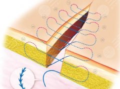 美容減張縫合凸起多久恢復(fù)平整?凸起多久能平？——恢復(fù)期全拆解