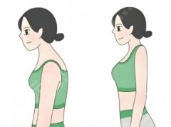 肩胛骨吸脂是哪個部位？別再把“后背厚”當(dāng)骨架大