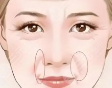 玻尿酸填充淚溝和法令紋后腫幾天？腫脹日歷公開(kāi)，附價(jià)格表和真實(shí)打分