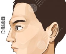 眉骨打玻尿酸會往下滑嗎？下滑概率到底幾成？給你拆個透