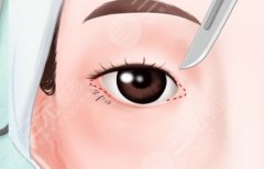切眉手術(shù)大概需要多少錢(qián)？從進(jìn)門(mén)到拆線(xiàn)，切眉錢(qián)包流血全記錄