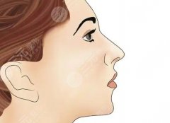 膨體墊下巴多久能恢復(fù)自然？真人時(shí)間線(xiàn)+價(jià)目表，不繞彎子