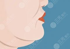 雙下巴黃金微雕恢復(fù)期，術(shù)后30天細(xì)節(jié)清單，直接照抄就行