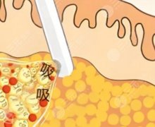 肩部吸脂好還是瘦肩針好？一文教你分清肩部吸脂和瘦肩針的區(qū)別