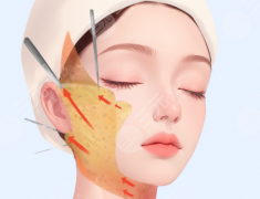 mini拉皮多久消腫？恢復(fù)時(shí)間、護(hù)理方式了解