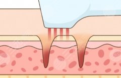 激光祛痘,和果酸換膚,哪個效果好？從原理到適用情況都講清楚，趕緊看