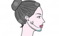 頦成型和假體隆下巴哪種好？從臉型基礎(chǔ)、效果持久性到維護(hù)難度全面對(duì)比