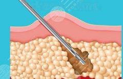 任學(xué)會(huì)吸脂怎么樣？術(shù)后滿(mǎn)意度、風(fēng)險(xiǎn)點(diǎn)和適合人群客觀(guān)整理