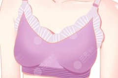 乳暈縮小手術(shù)有后遺癥嗎？可能風險、疤痕情況和感覺變化詳細解析