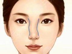 鼻梁填充用什么材料好？3種主流鼻梁填充材料實(shí)測(cè)來(lái)了