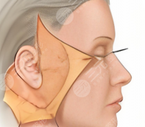 五層提升和大拉皮的區(qū)別有哪些？這兩個項目的區(qū)別拆解開來了，速看