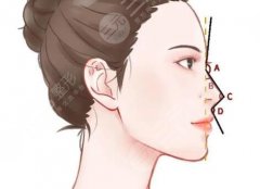 鼻中隔軟骨隆鼻副作用是什么？先搞清楚這些副作用，醫(yī)美黨必看