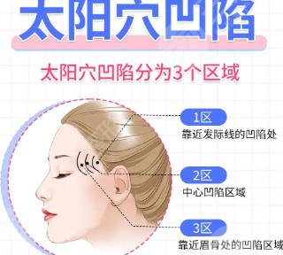 豐太陽穴、