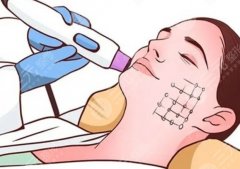 廈門三甲醫(yī)院熱瑪吉，面診必問問題+術(shù)后護(hù)理重點(diǎn)