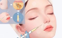 脂肪填充北京哪個醫(yī)院好？醫(yī)院怎么篩、醫(yī)生怎么問，關(guān)鍵點(diǎn)都在這