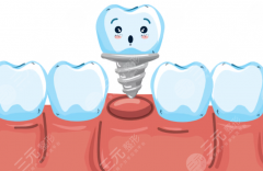 內(nèi)江醫(yī)大口腔種植牙怎么樣？多少錢(qián)？技術(shù)亮點(diǎn)和收費(fèi)情況這篇說(shuō)清