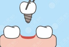 義烏義惠口腔種植牙怎么樣？多少錢(qián)？做一顆和做多顆的單價(jià)差距到底有多大？