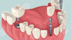 南通美奧口腔種植牙怎么樣？多少錢(qián)？不同檔位種植體的收費(fèi)區(qū)間幫你整理好了