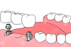 南昌貝爾口腔種植牙怎么樣？多少錢(qián)？半口種植和單顆種植的費(fèi)用邏輯完全不一樣