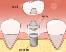 襄陽(yáng)谷城時(shí)代口腔種植牙怎么樣？多少錢(qián)？別急著下單先看這幾個(gè)關(guān)鍵指標(biāo)